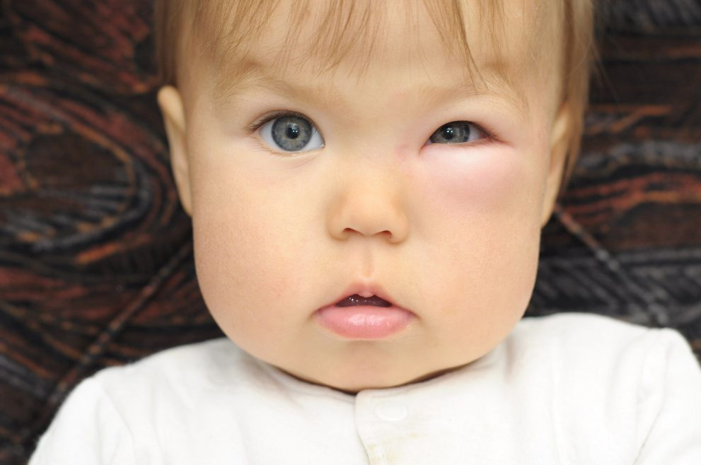 Baby With A Swollen Eye From An Insect Bite Luxury Screens